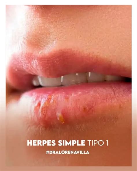Fotografía de un recién nacido con lesiones de herpes simple en la piel