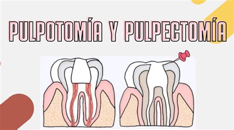 Diagrama comparativo de pulpotomía y pulpectomía.