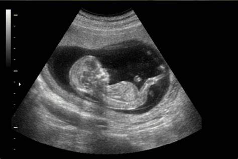 Foto de una ecografía mostrando el sexo del bebé