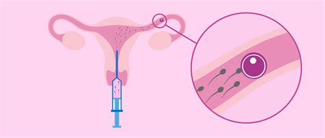 Representación gráfica de la inseminación artificial intrauterina