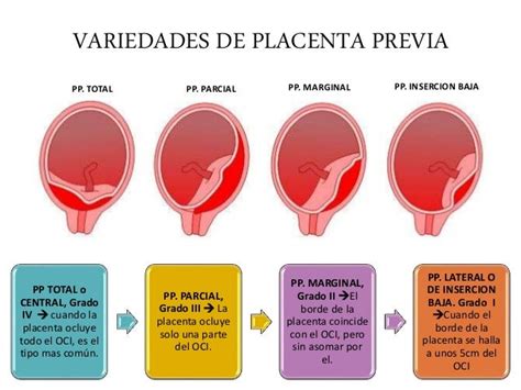 Infografía: Tipos de placenta previa (marginal, parcial, completa)