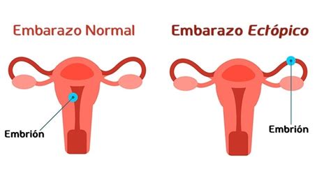 Infografía comparativa de un embarazo normal y un embarazo ectópico, mostrando la ubicación de la implantación.