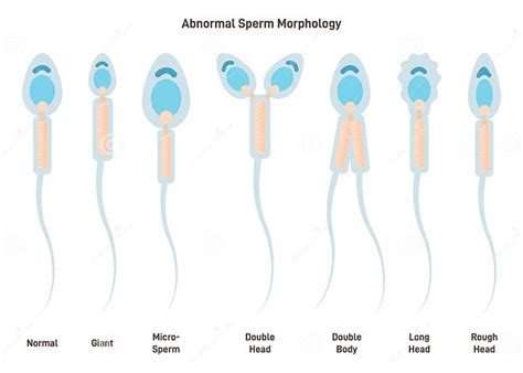 micrografía de espermatozoides con morfología normal y anormal