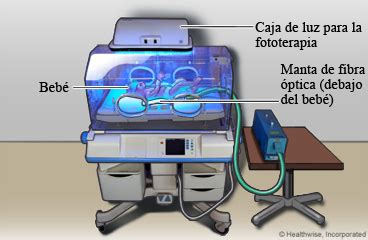 Bebé recibiendo fototerapia para ictericia
