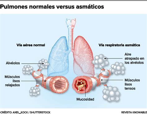 Esquema de las vías respiratorias normales vs. asmáticas