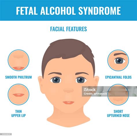 Ilustración comparativa de rasgos faciales típicos del síndrome alcohólico fetal frente a un rostro sin afectación.