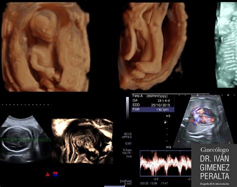 Ecografía 3D de un feto de 17 semanas mostrando sus rasgos faciales y cuerpo