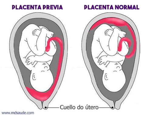 Comparativa entre una placenta de inserción normal y una placenta previa
