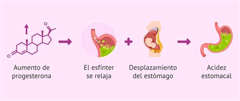 Esquema de las causas de la acidez en el embarazo