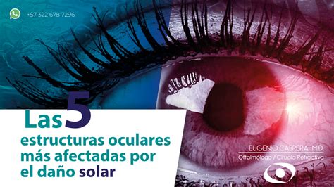 Esquema de las estructuras oculares afectadas por uveítis en potros