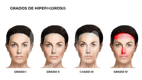 Niño con hiperhidrosis craneofacial mostrando incomodidad