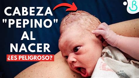 Foto de la cabeza de un recién nacido con cefalohematoma