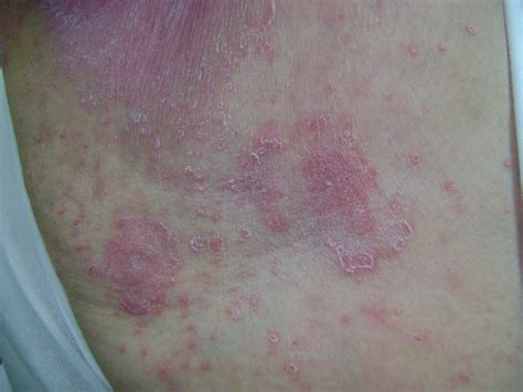 Candidiasis del pañal con lesiones satélite