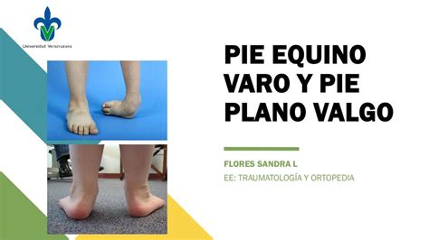 Esquema de las técnicas quirúrgicas utilizadas en la corrección del pie equino varo