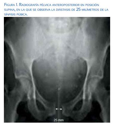 Radiografía pélvica mostrando diástasis de la sínfisis del pubis con separación de las ramas púbicas.