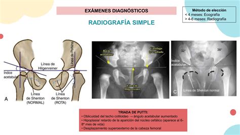 Ejemplo de ecografía de cadera en un bebé y radiografía de pelvis en un niño mayor con displasia