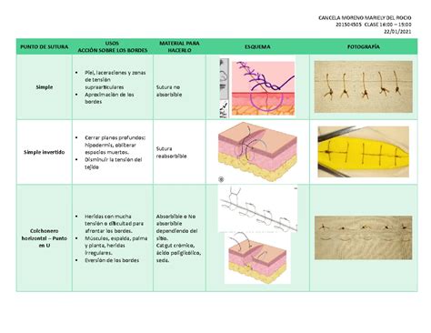 Esquema de las incisiones en una cesárea
