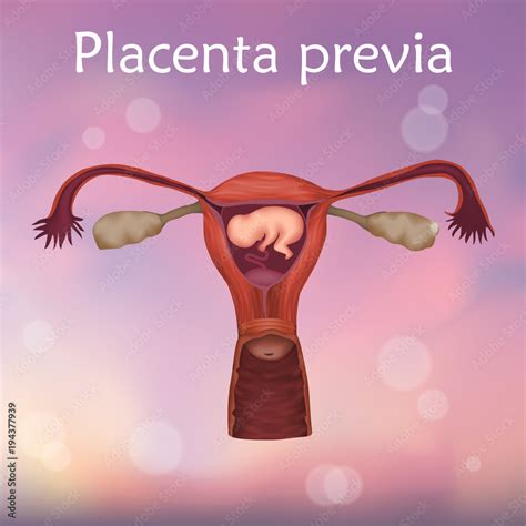 Ilustración anatómica del útero con placenta previa, mostrando la placenta cubriendo el cuello uterino.