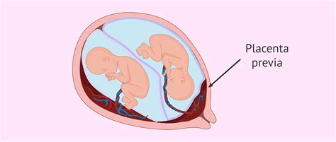 Ecografía mostrando la placenta previa cubriendo parcialmente el cuello uterino.