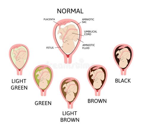representación visual de los diferentes colores del líquido amniótico y su posible significado