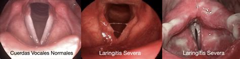 Ilustración de las cuerdas vocales inflamadas en una mujer embarazada