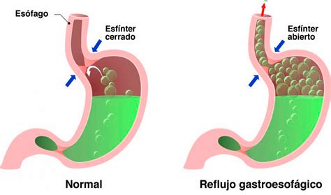 Diagrama mostrando el reflujo gastroesofágico en una mujer embarazada