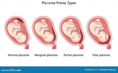 Gráfico comparativo de los diferentes tipos de placenta adherida (accreta, increta, percreta).