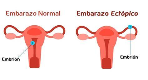 infografía que muestra la diferencia entre un embarazo normal y un embarazo ectópico, destacando la implantación del óvulo fuera del útero.