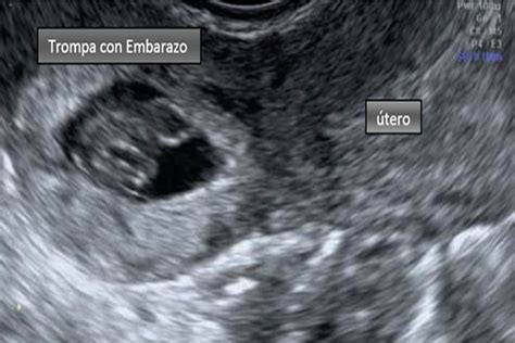 imagen de una ecografía transvaginal que muestra un embarazo ectópico.