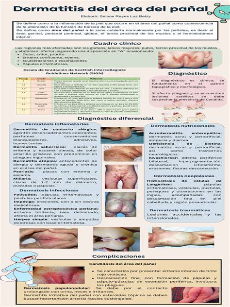 Esquema de las zonas afectadas por la dermatitis del pañal en un bebé