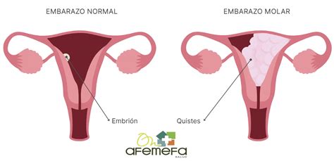 Representación visual de un útero con un embarazo molar, mostrando la masa anormal en lugar de un embrión.