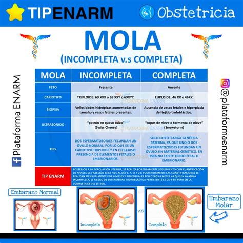 Diagrama comparativo de la mola hidatiforme completa e incompleta, mostrando la dotación cromosómica y la presencia o ausencia de tejido fetal.