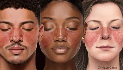 Foto de mujer con erupción malar característica del lupus