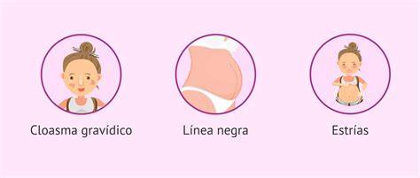 Esquema de las manchas en la piel o cloasma gravídico durante el embarazo