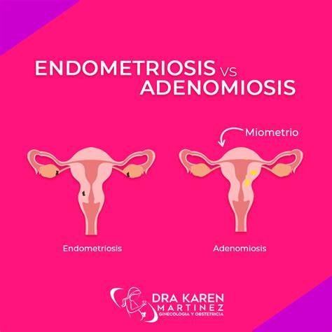 Diagrama que ilustra la endometriosis y la adenomiosis dentro y fuera del útero.