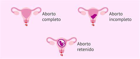 Ilustración de una mujer experimentando cólicos abdominales durante un aborto incompleto