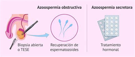 Ilustración comparativa de azoospermia obstructiva y secretoria.