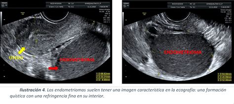 Ecografía pélvica mostrando quistes de endometriosis
