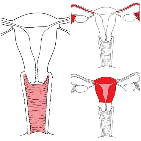 Esquema del sistema reproductor femenino antes y después de una ooforectomía unilateral