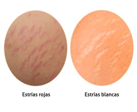 Comparación visual detallada de estrías rojas versus estrías blancas o plateadas en la piel
