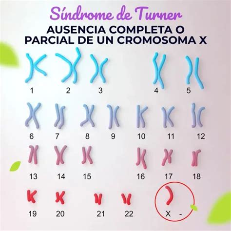Representación esquemática del cariotipo femenino y la ausencia de un cromosoma X en el Síndrome de Turner