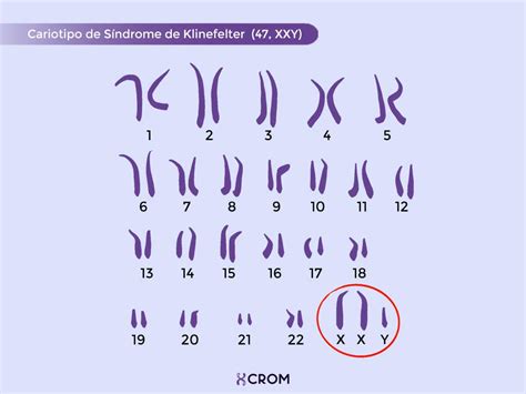 Representación esquemática del cariotipo masculino mostrando el cromosoma Y adicional en el Síndrome de Klinefelter