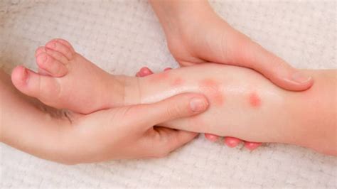 Foto de primer plano de la piel de un bebé con dermatitis del pañal, mostrando enrojecimiento y algunas manchas.