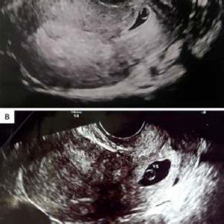 imagen de una ecografía transvaginal mostrando un saco gestacional vacío