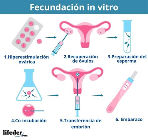 Esquema del proceso de fecundación in vitro