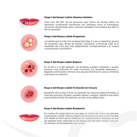 Esquema de las etapas del herpes labial