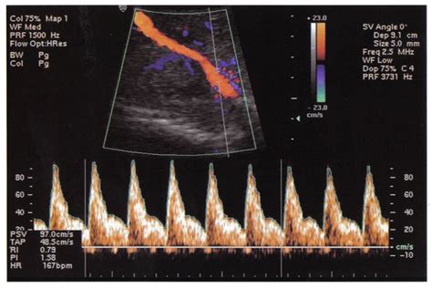 Técnica de ecografía Doppler para la medición del índice de pulsatilidad en la arteria uterina.