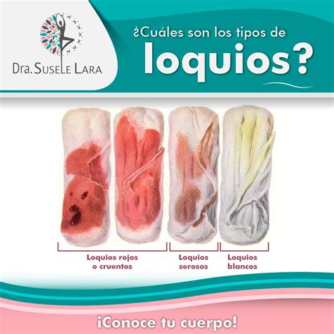 Esquema comparativo entre loquios, sangrado transitorio y menstruación posparto