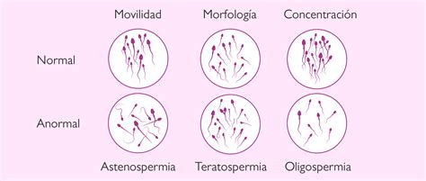 Infografía sobre las diferentes alteraciones espermáticas