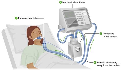 Ilustración de un paciente intubado con un equipo de ventilación mecánica, mostrando los parámetros en el monitor